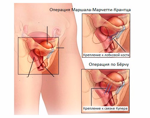Хирургическое лечение недержания мочи в Краснодаре