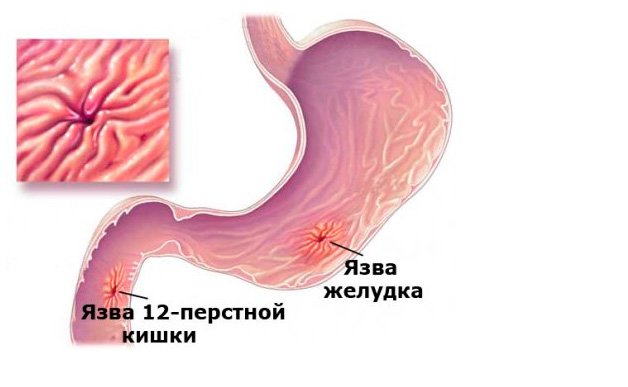 Лечение язвы в Краснодаре